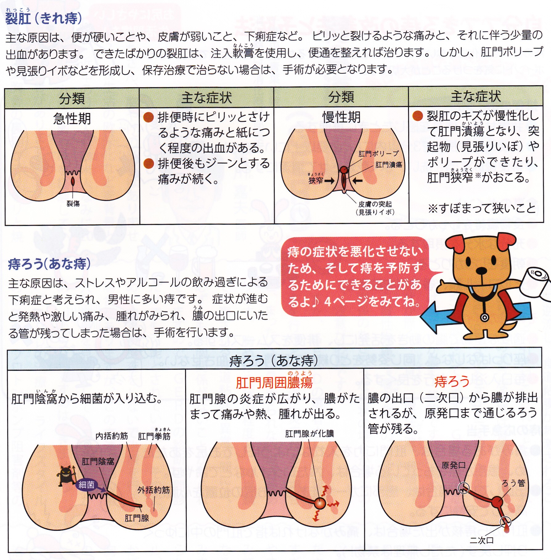 裂肛（きれ痔）と肛門周囲膿瘍、痔ろうの種類一覧